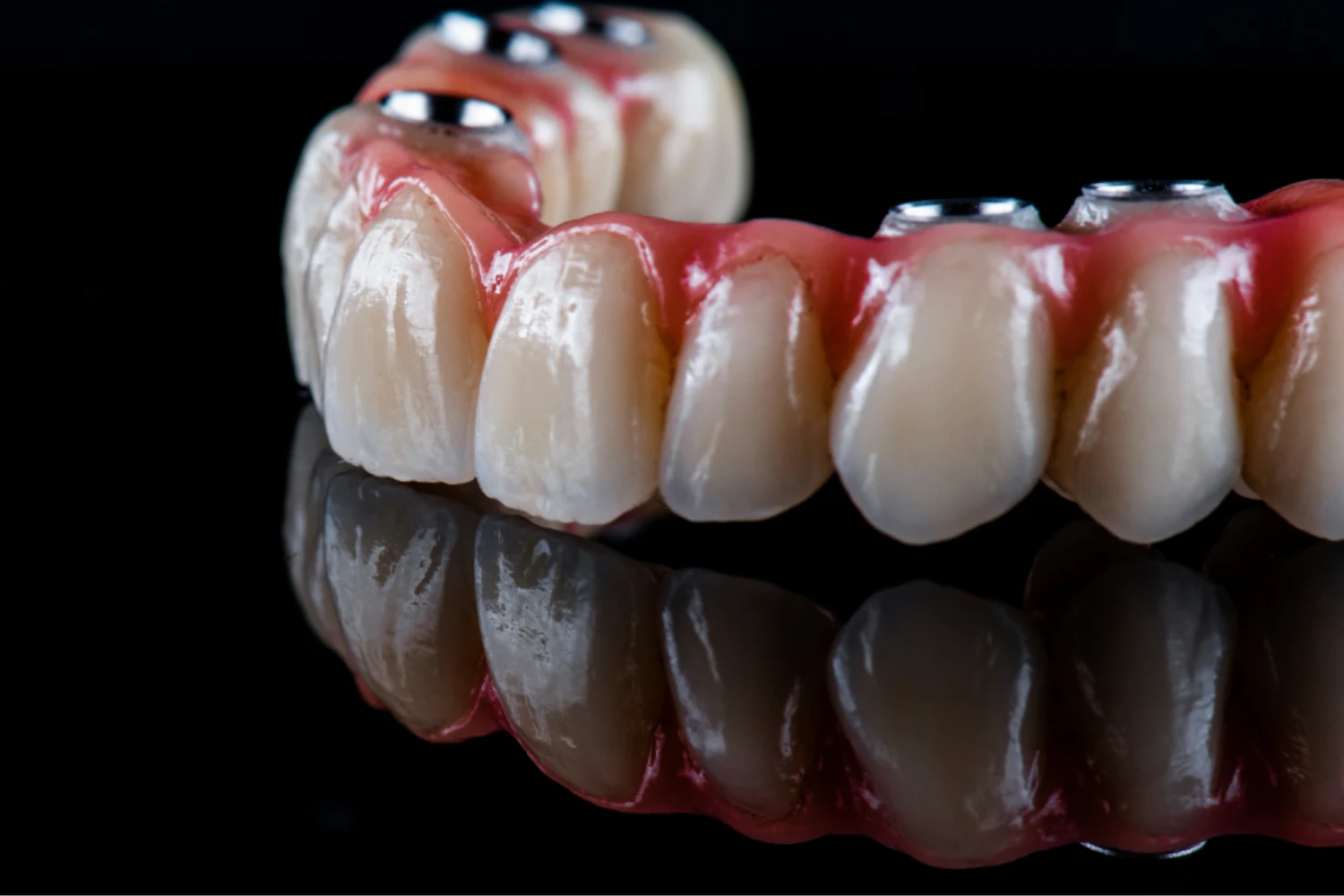 All-on-4 and All-on-6 implants at Bridge Dental Clinic