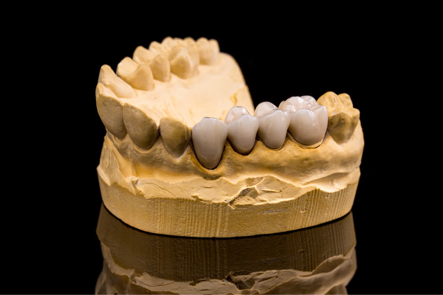 Dental bridges at Bridge Dental Clinic