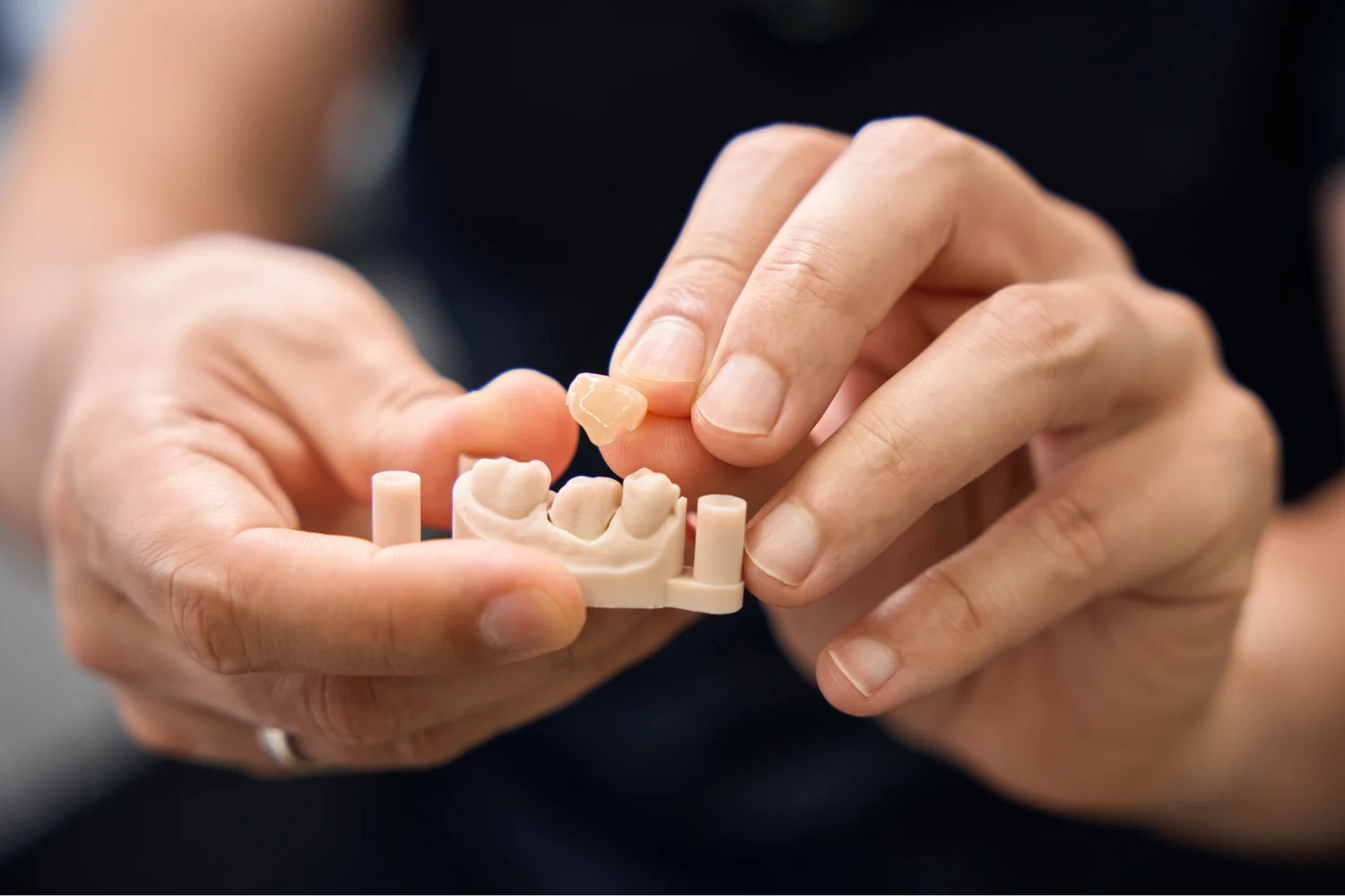 Dental crowns at Bridge Dental Clinic