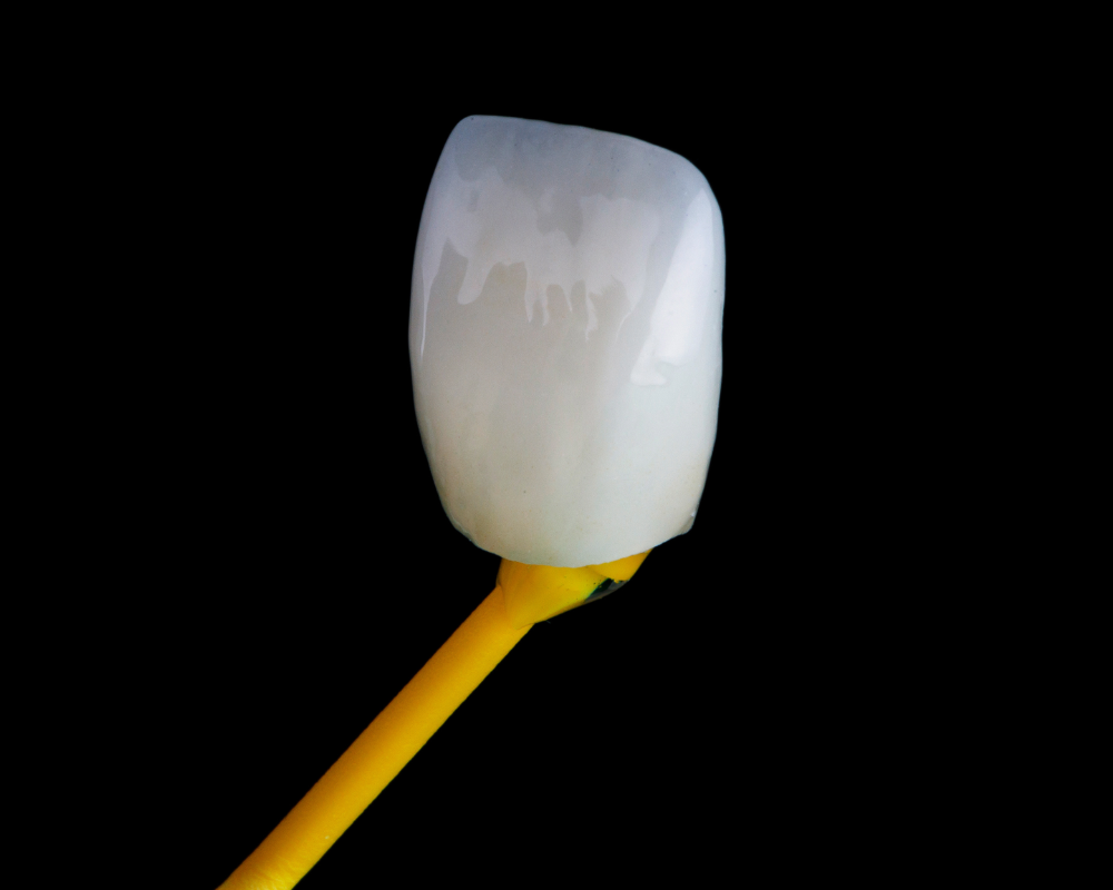 Porcelain veneers at Bridge Dental Clinic in Telford